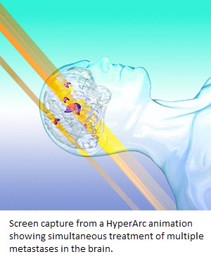 Screen capture from a HyperArc animation showing simultaneous treatment of multiple metastases in the brain