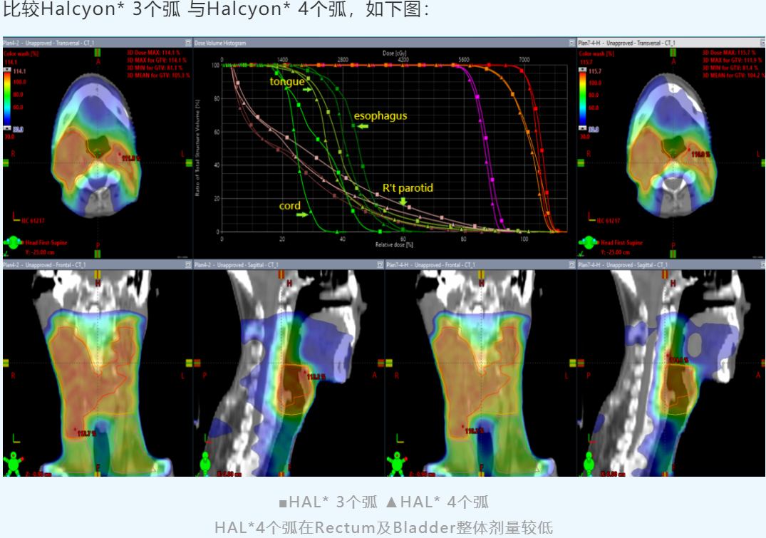 亚洲大学附属医院 | Halcyon多癌种治疗计划的剂量优化