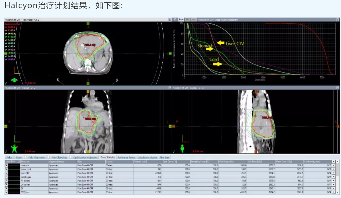 亚洲大学附属医院 | Halcyon多癌种治疗计划的剂量优化