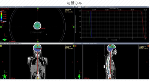 全新一代Halcyon双中心计划的救命魅力！金沙洲医院国际肿瘤中心经验分享